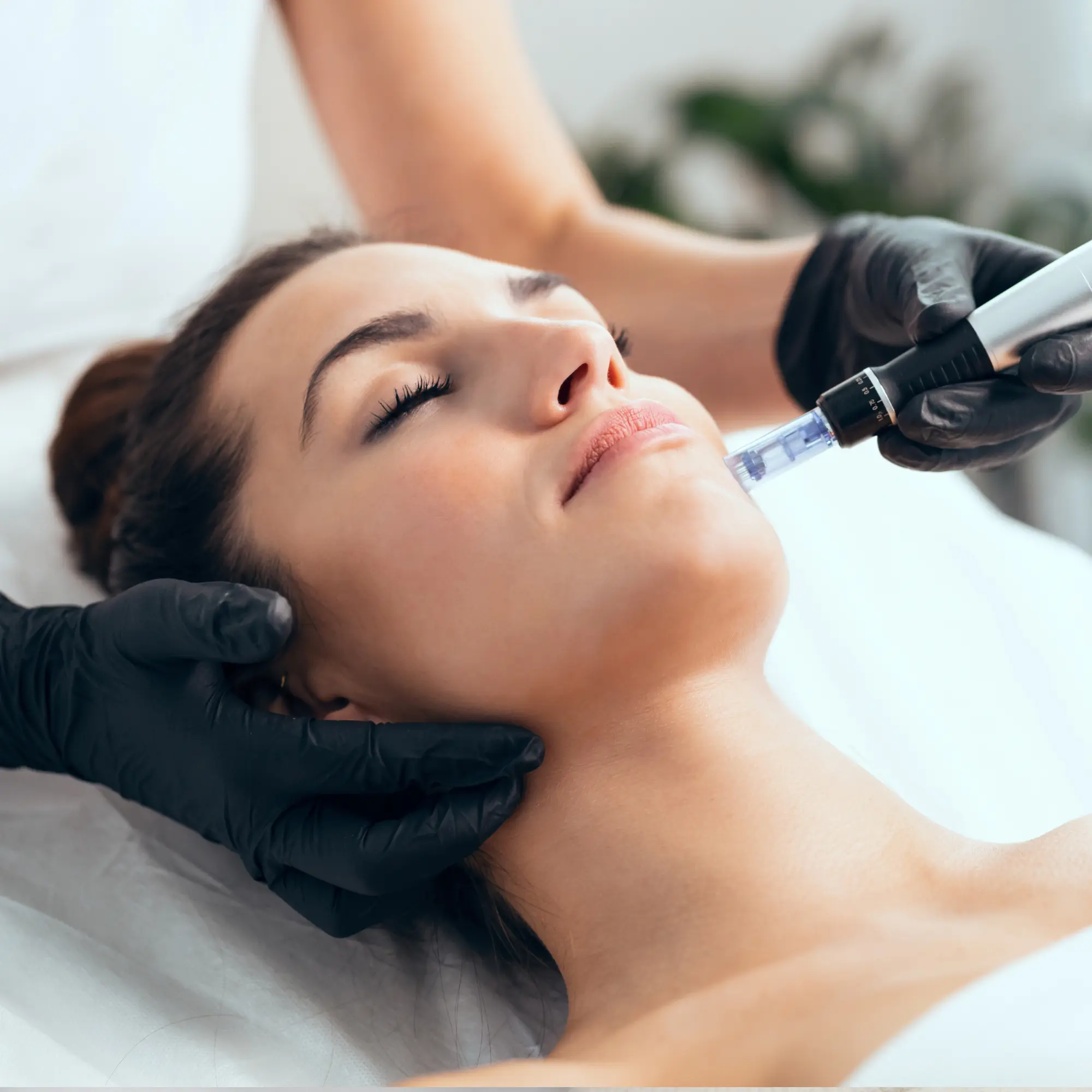 Microneedling