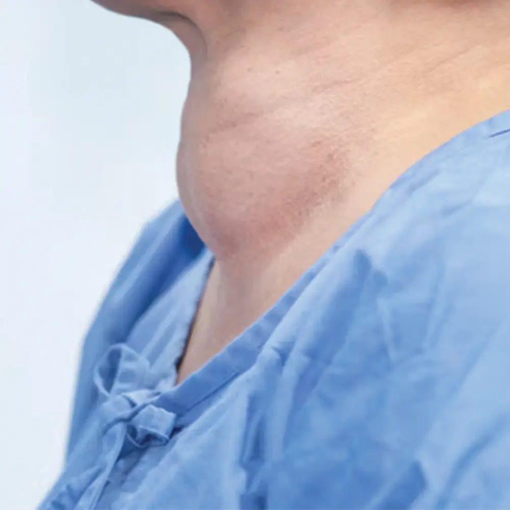 Thyroid Related Issues