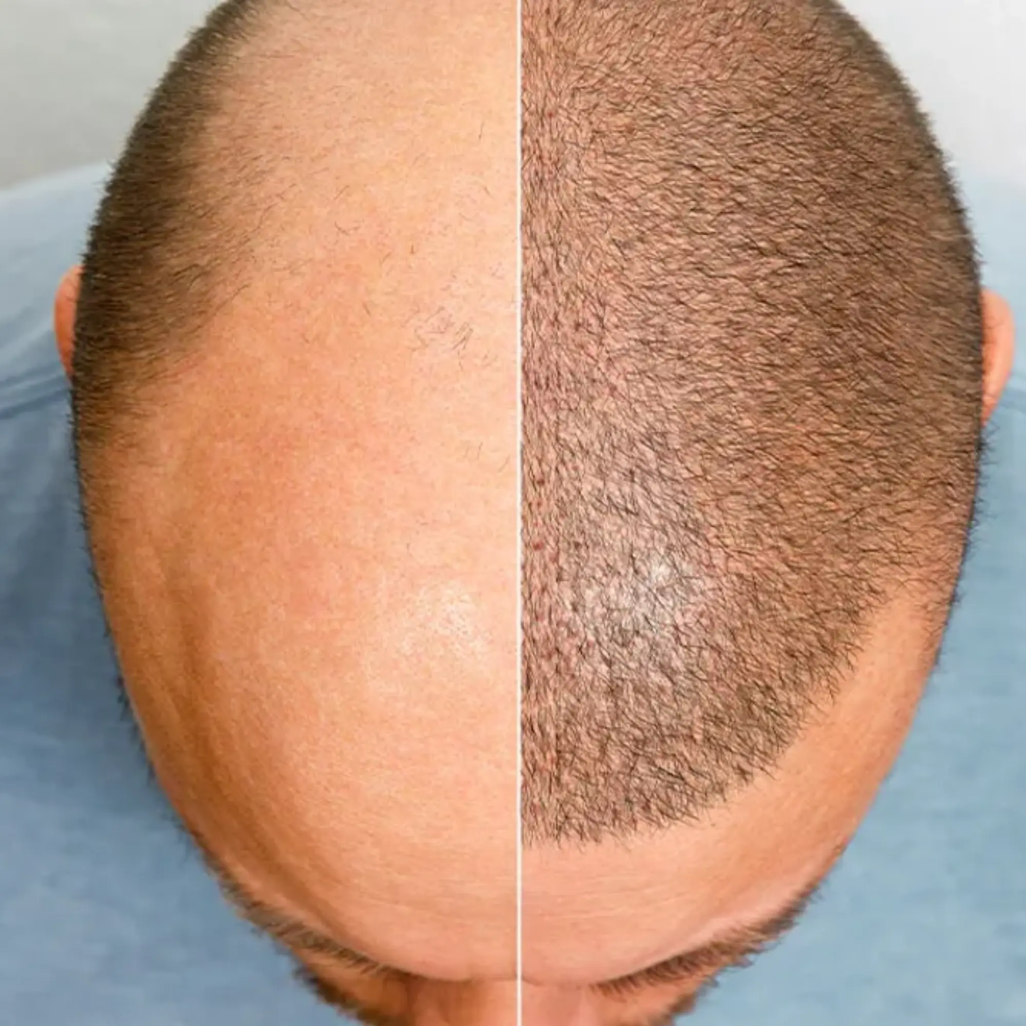 Fue Hair Transplant